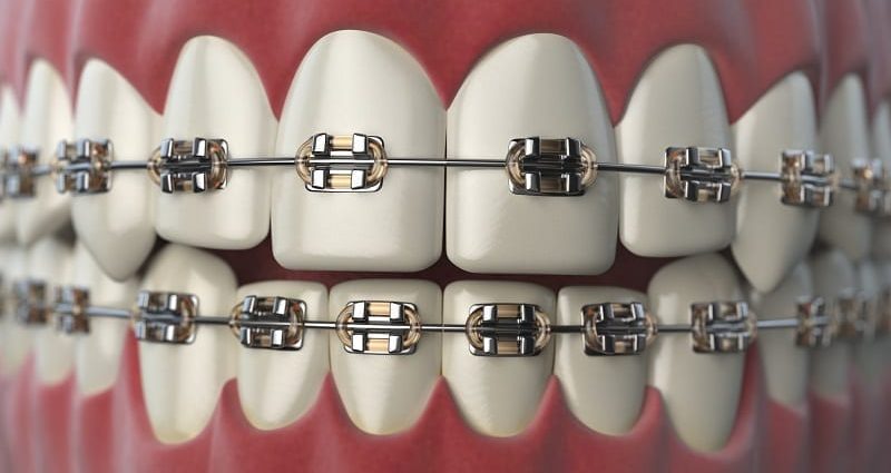 Teeth braces. Types of orthodontic appliances, price