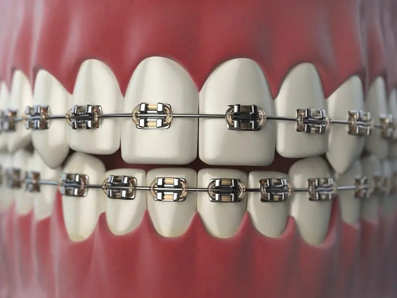 Teeth braces. Types of orthodontic appliances, price