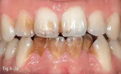 Teeth discoloration