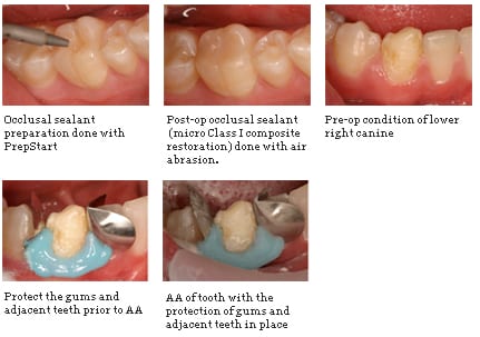 Teeth sandblasting &#8211; indications, procedure, price. What is sandblasting and what does it do?