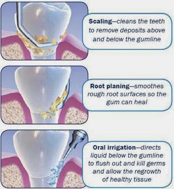 Teeth scaling &#8211; methods, recommendations, contraindications. What is scaling?