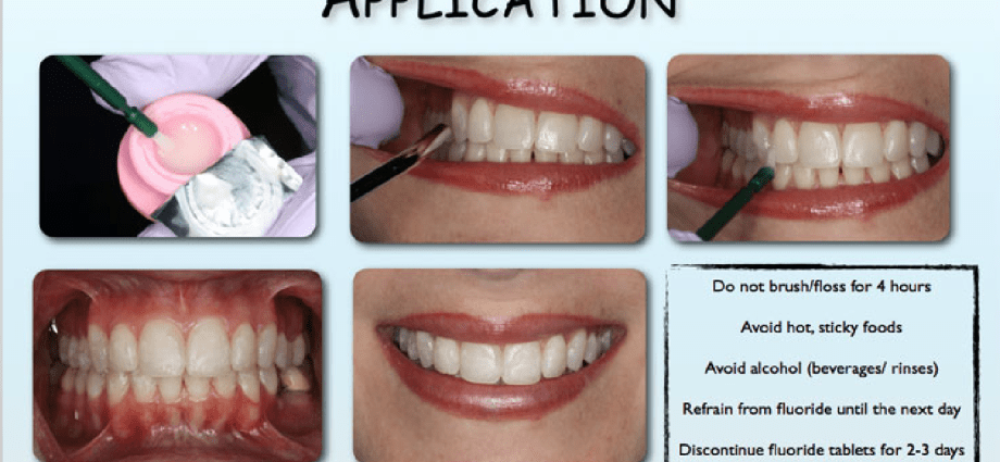 Teeth varnishing &#8211; what is it and is it worth it?