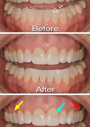 Teeth whitening &#8211; a way to make a snow-white smile. Teeth whitening in the office and with home methods, reasons for discoloration