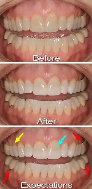 Teeth whitening &#8211; a way to make a snow-white smile. Teeth whitening in the office and with home methods, reasons for discoloration