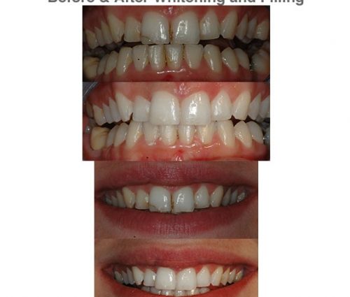 Teeth whitening and fillings. Is it possible to whiten the fillings?