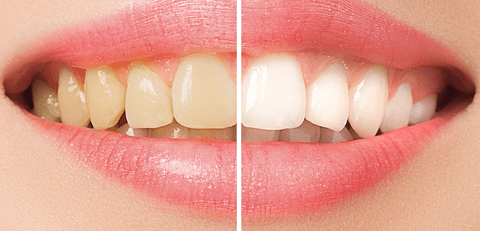 Teeth whitening and smoking. Does whitening make sense for a smoker?