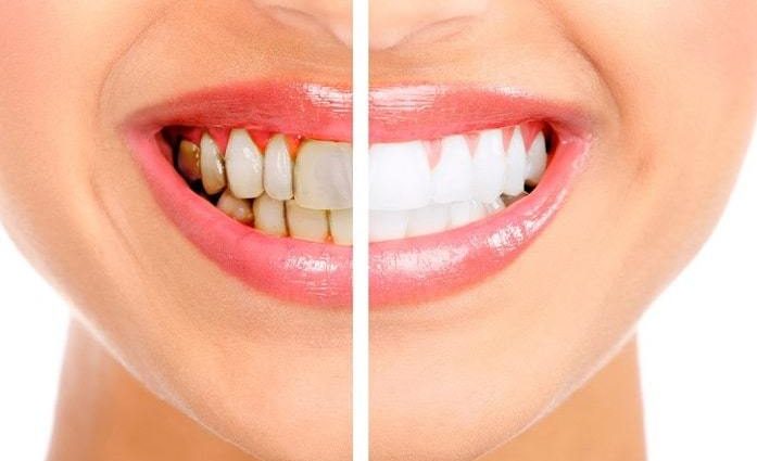 Teeth whitening at home &#8211; is it effective? Overview of the most popular methods