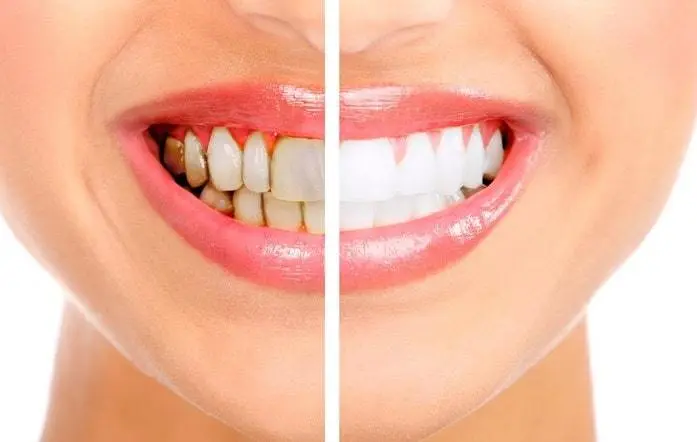 Teeth whitening at home &#8211; is it effective? Overview of the most popular methods