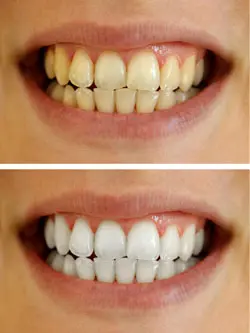 Teeth whitening &#8211; home methods or at the dentist&#8217;s?