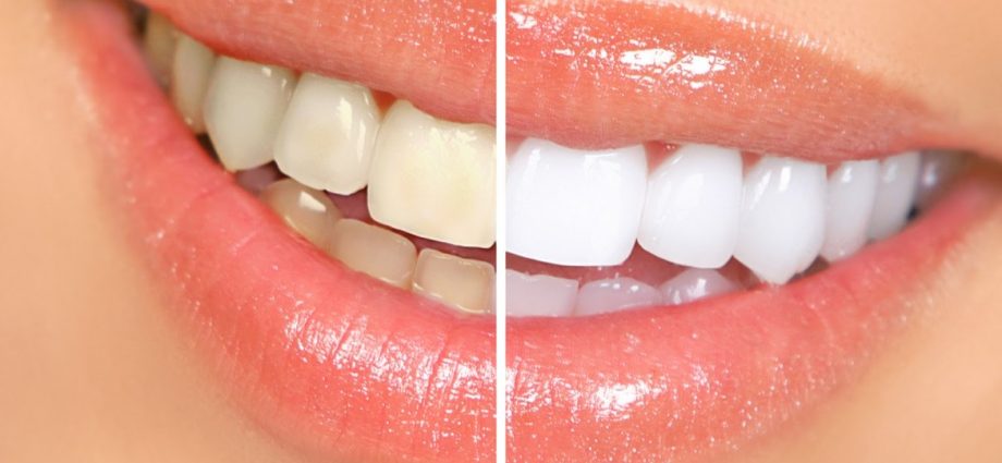 Teeth whitening &#8211; how much does it cost?