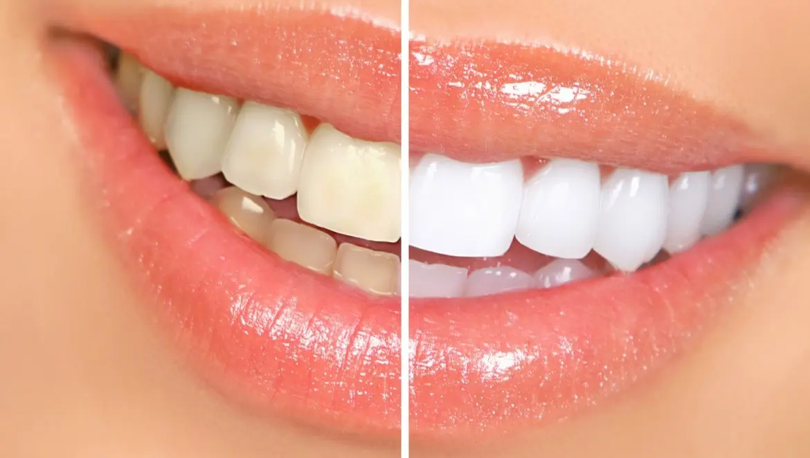 Teeth whitening &#8211; how much does it cost?