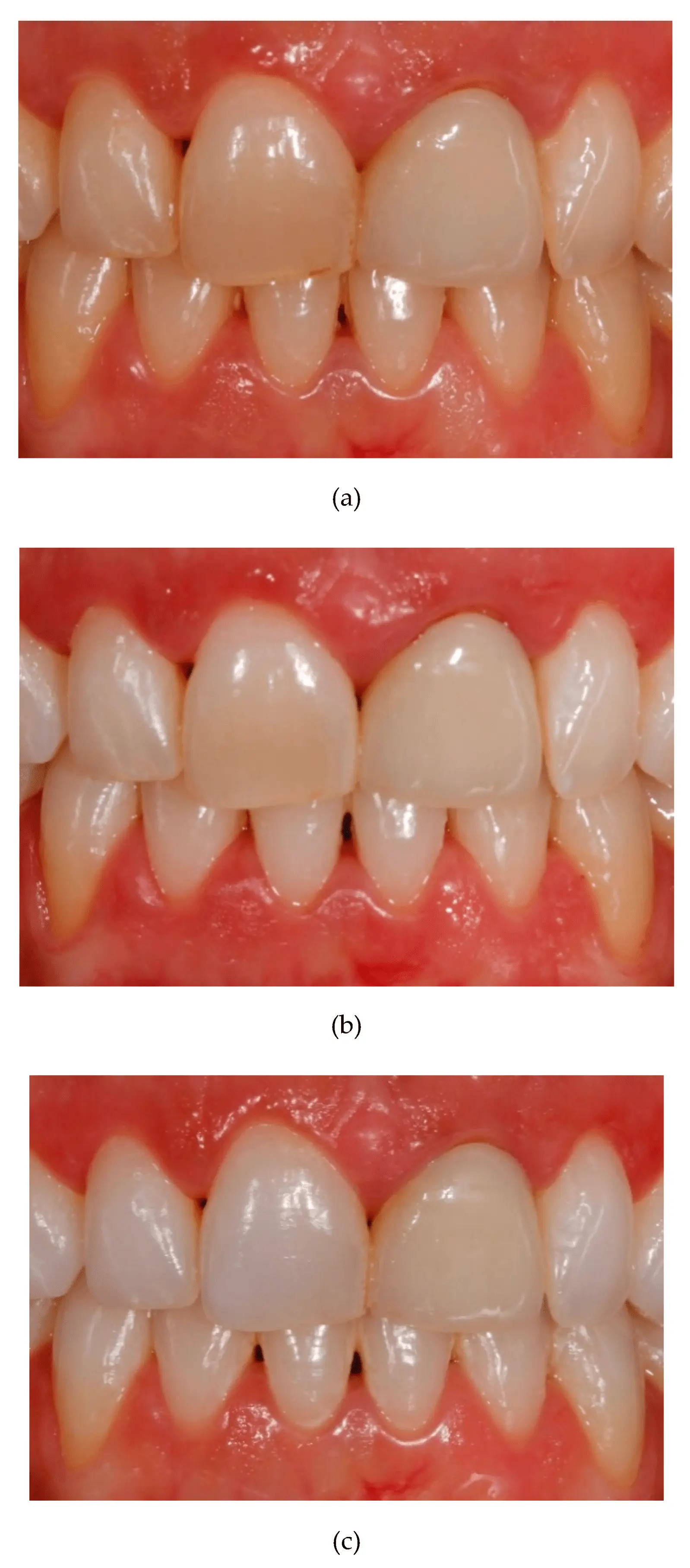 Teeth whitening &#8211; procedures performed independently, procedures performed under the supervision of a doctor