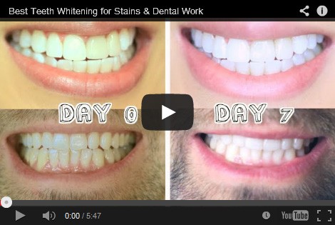 Teeth whitening &#8211; reviews