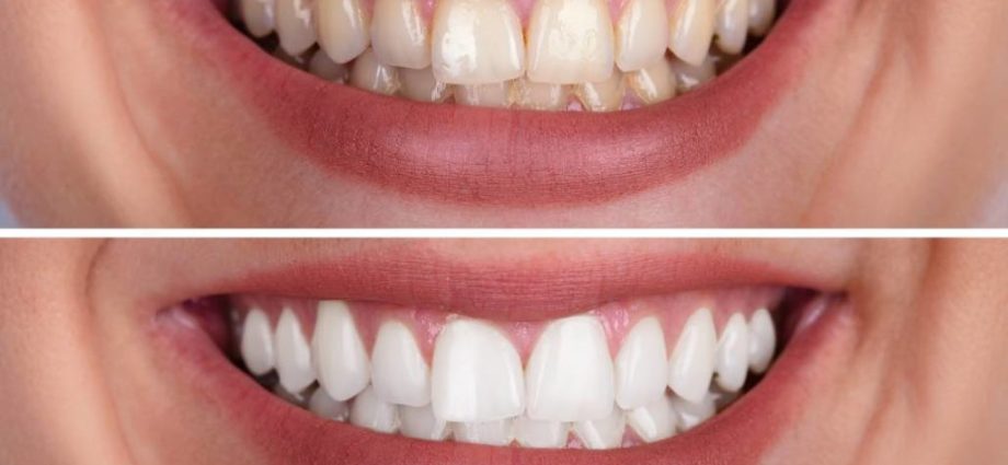 Teeth whitening &#8211; what are the results?