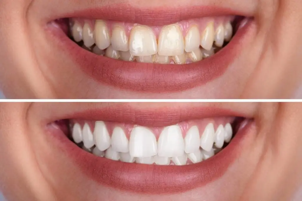 Teeth whitening &#8211; what are the results?