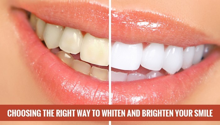 Teeth whitening &#8211; which method to choose?