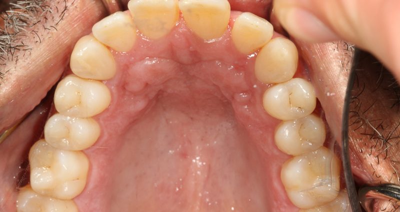 Teeth without caries