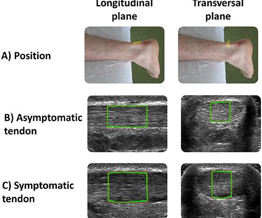 Tendon ultrasound &#8211; indications and the course of the examination