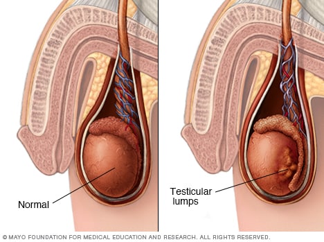 Testicular diseases