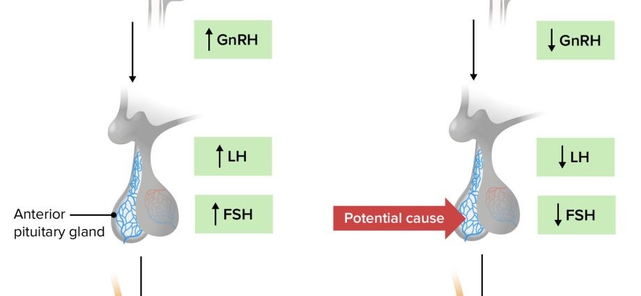 Testicular Hormonal Failure &#8211; Definition. Types of hypogonadism