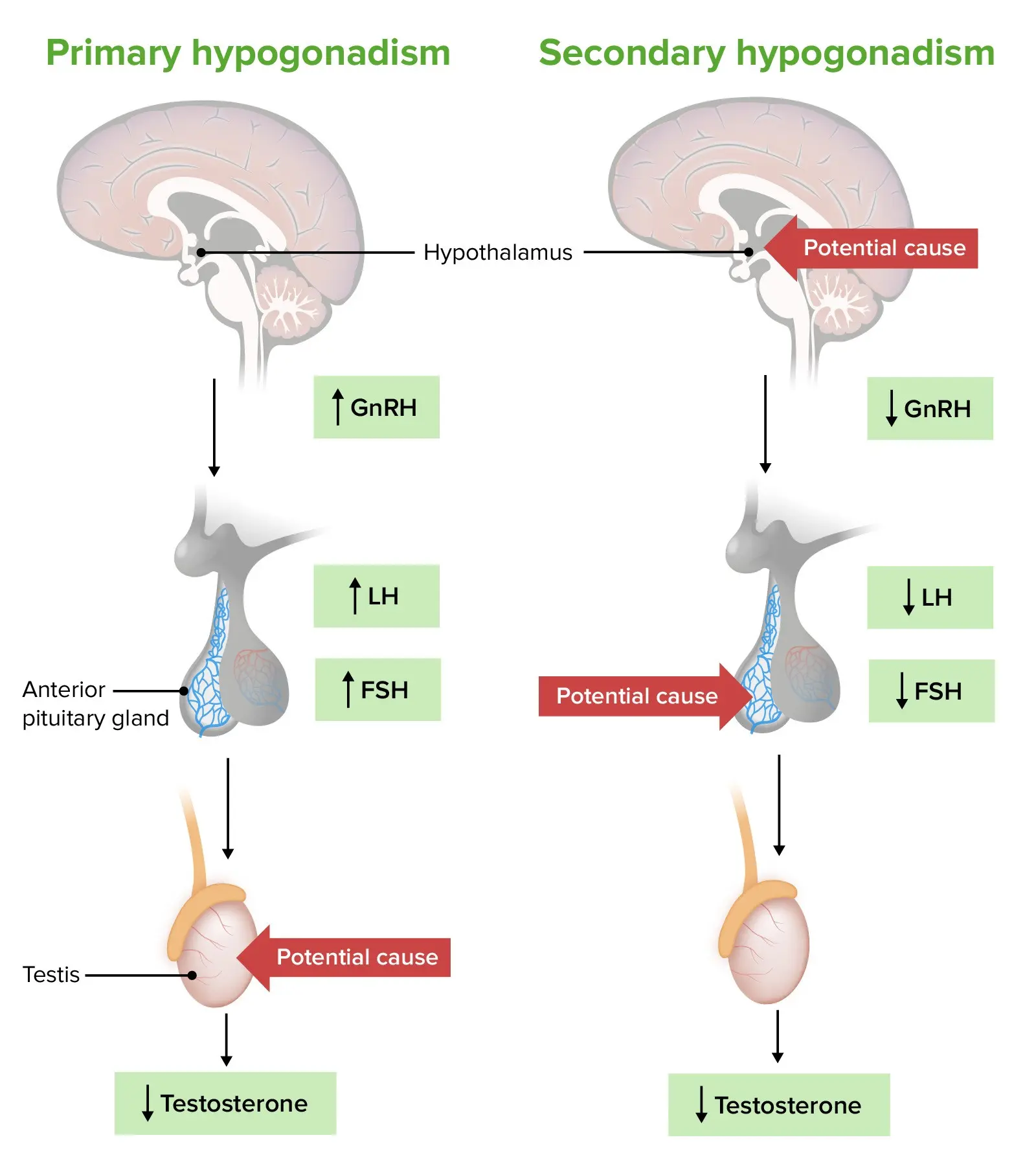 Testicular Hormonal Failure &#8211; Definition. Types of hypogonadism