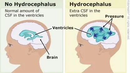 Testicular hydrocephalus &#8211; causes, symptoms, treatment methods