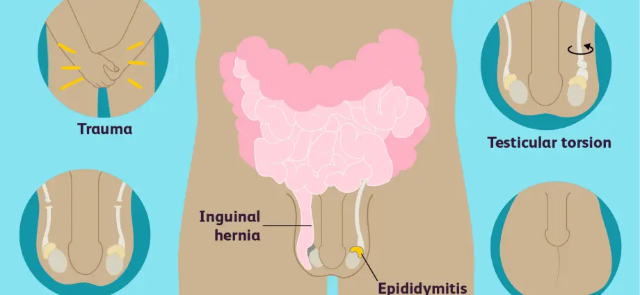 Testicular (testicular) pain &#8211; causes, procedures