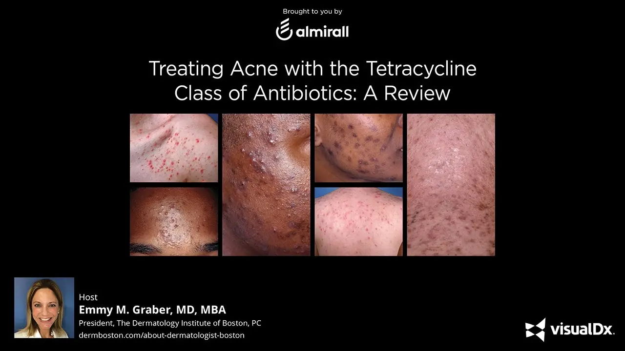 Tetracyclinum TZF &#8211; a drug for common acne. How does tetracycline work?