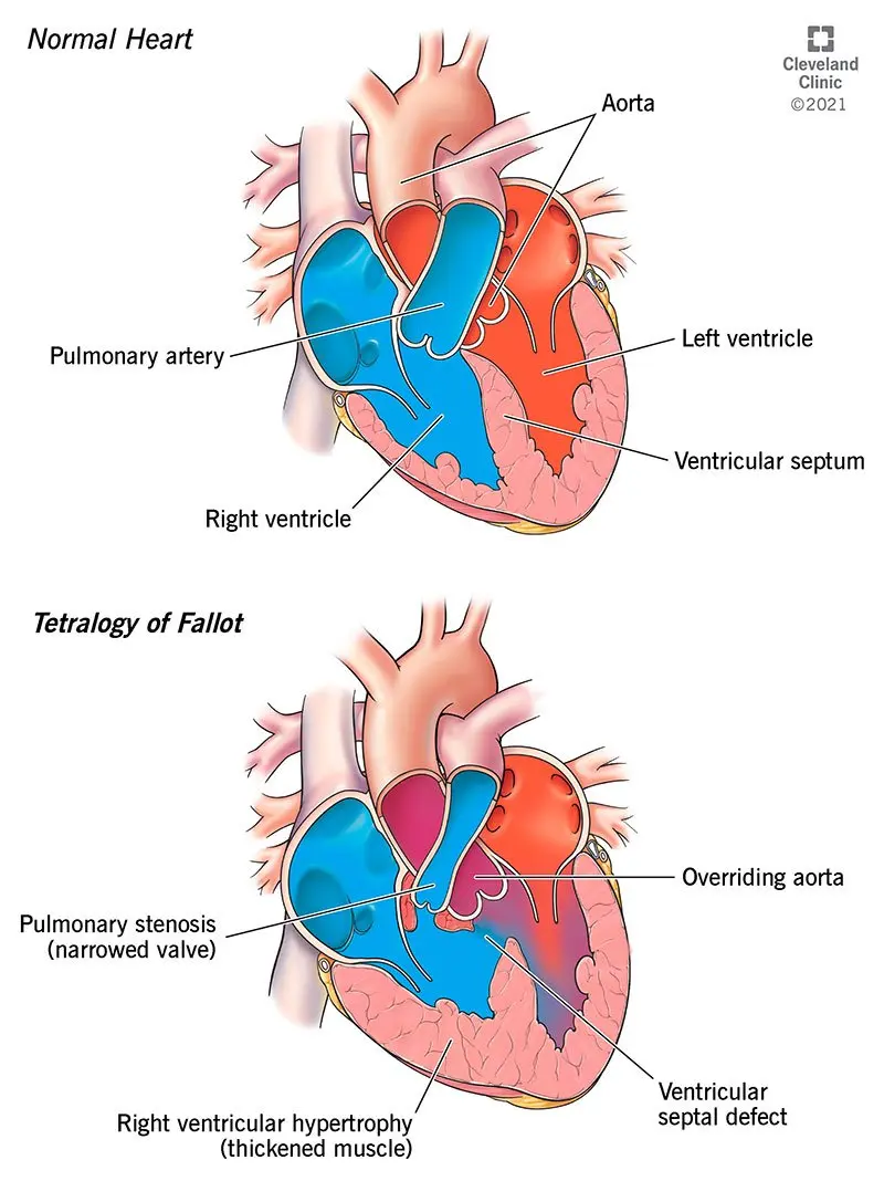 Tetralogy of Fallot (Fallot syndrome, ToF) &#8211; causes, symptoms, home management, treatment