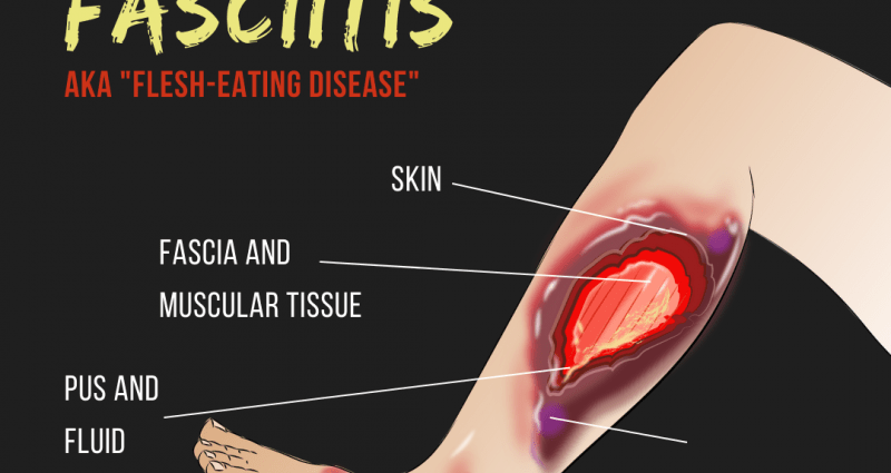 The bacteria that were eating my body