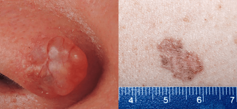 The cancer is visible on the skin. How to recognize its symptoms?