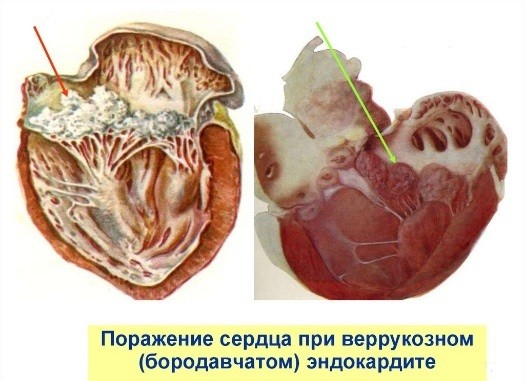 The causative agent of swine erysipelas