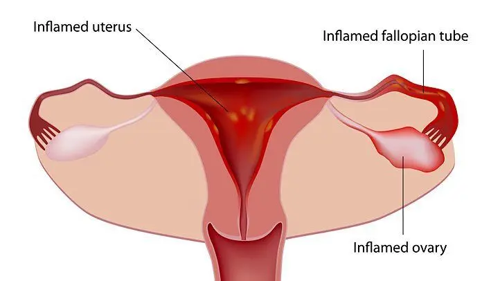 The causes of painful periods