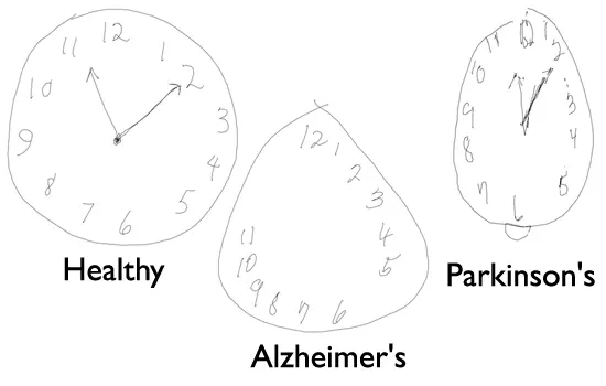 The Clock Drawing Test helps you detect Alzheimer&#8217;s disease early. What is it about?
