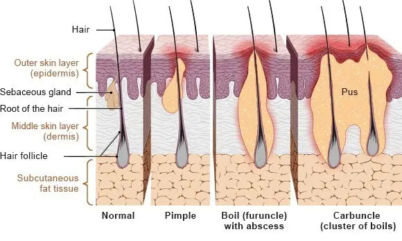 The cluster boil, or carbuncle