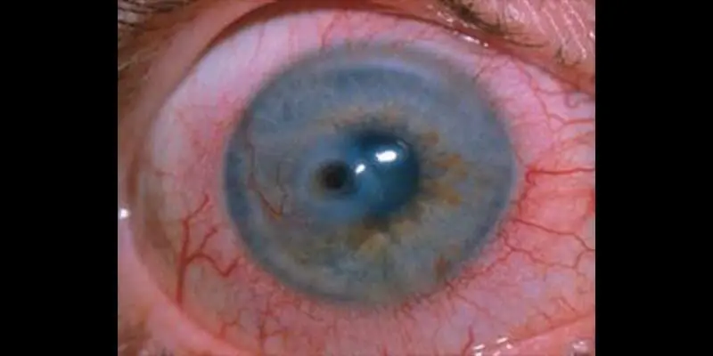 The cornea of ​​the eye. Inflammation and degeneration of the cornea