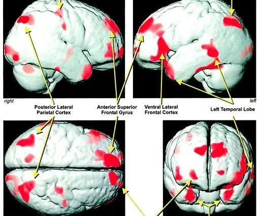 The damage to the brain from sleep apnea is reversible