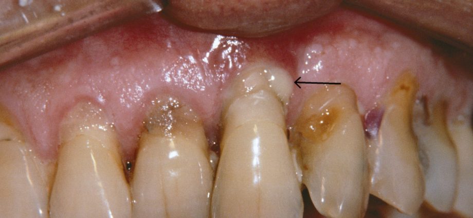 The disease begins with… teeth