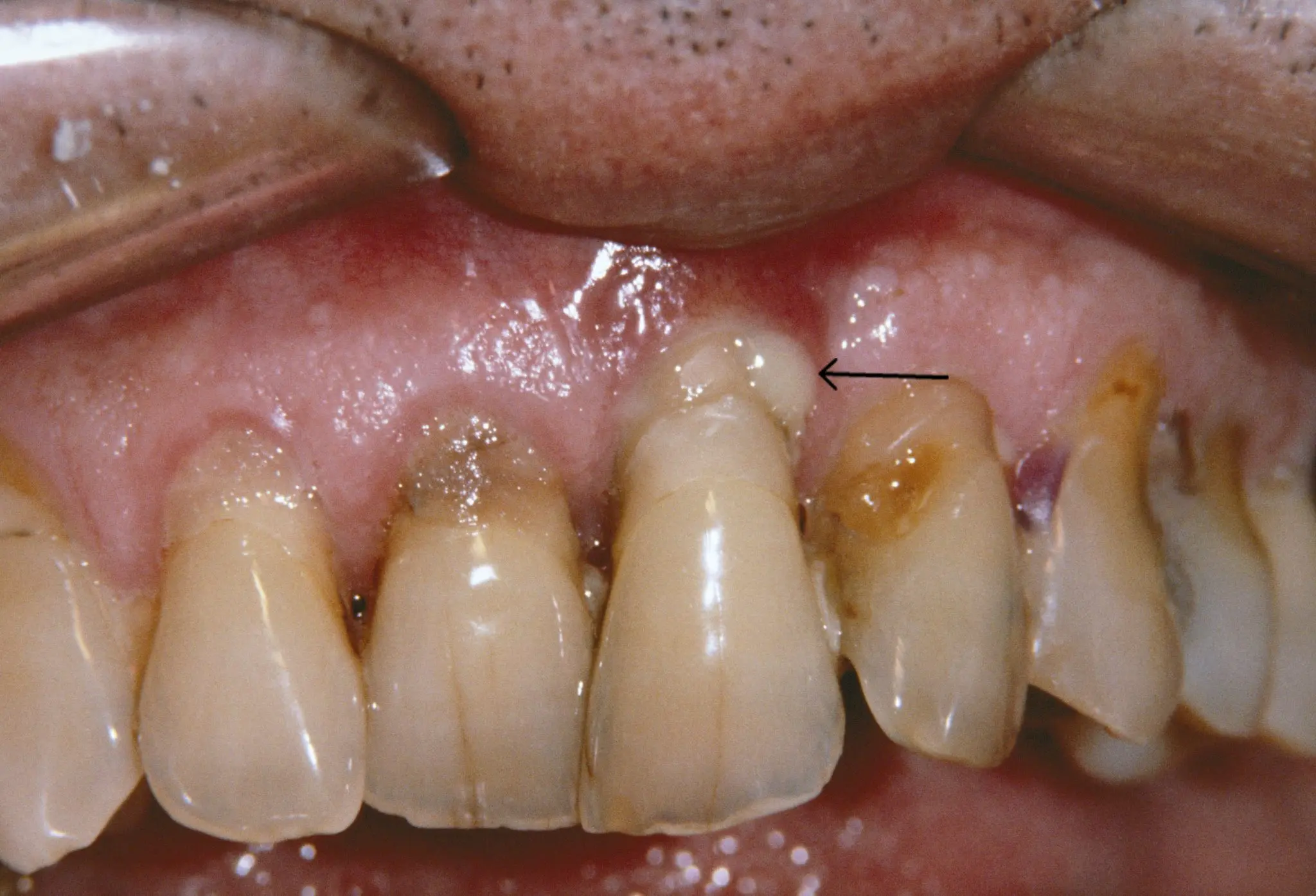 The disease begins with… teeth