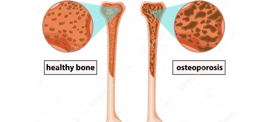 The disease is not only the old ladies. Facts and myths about osteoporosis