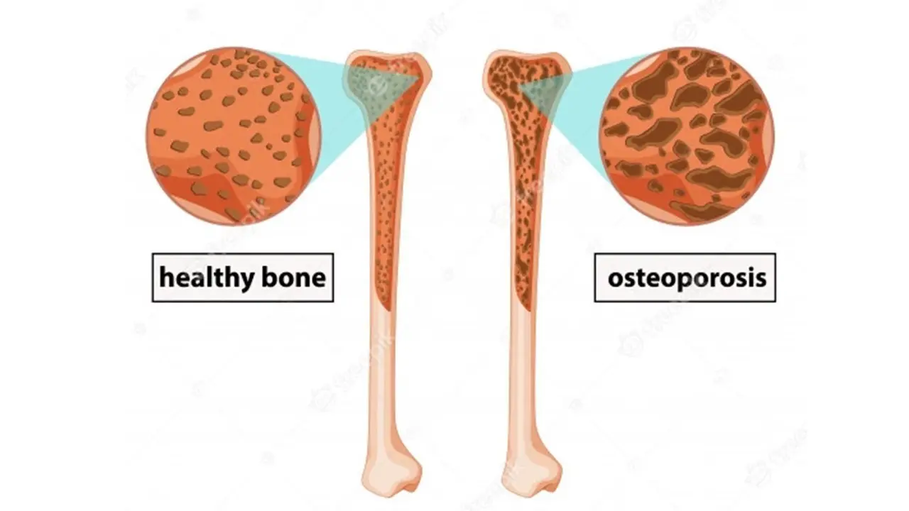 The disease is not only the old ladies. Facts and myths about osteoporosis