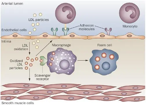 The early stages of atherosclerosis can appear in obese children