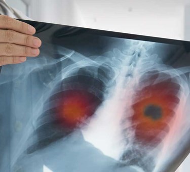 The first hope in years for patients with small cell lung cancer