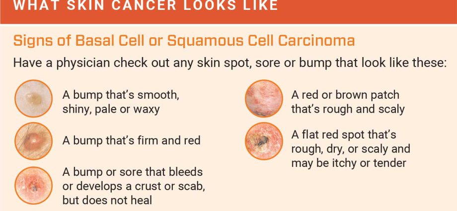 The first sign of a tumor can be seen on the skin. Dermatologist: with such a change, see a doctor quickly