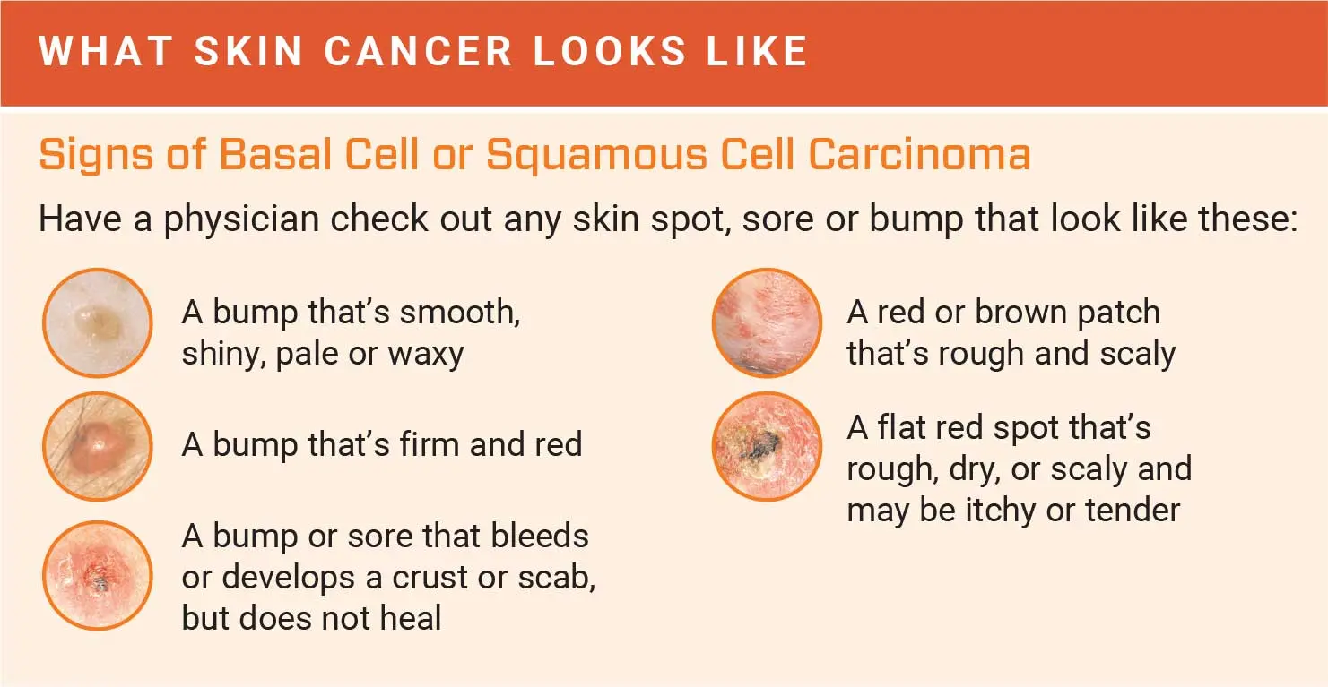 The first sign of a tumor can be seen on the skin. Dermatologist: with such a change, see a doctor quickly