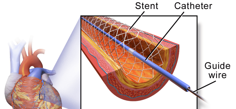 The first soluble stent was implanted in Wrocław