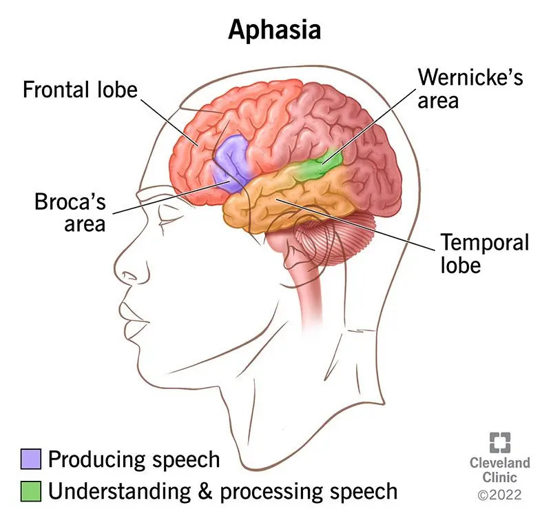 The first symptoms of aphasia. &#8220;The sick themselves notice that something is wrong&#8221;