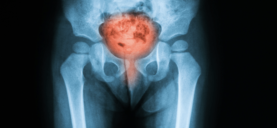 The first symptoms of cystitis. How not to miss them?