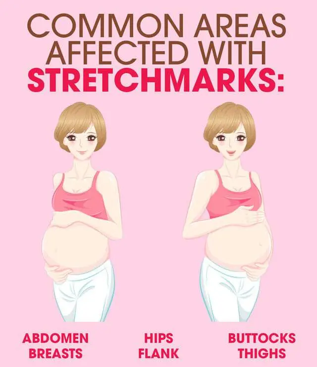 The five most effective ways to treat stretch marks