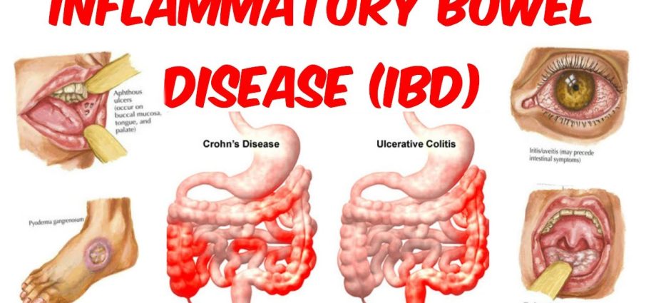 The five worst bowel diseases